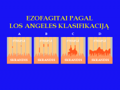 Ezofagitai (stemplės pažeidimas) pagal LOS ANGELES klasifikaciją